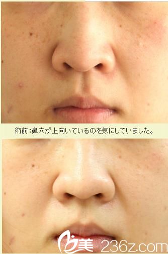 鼻翼缩小术 鼻翼缩小术