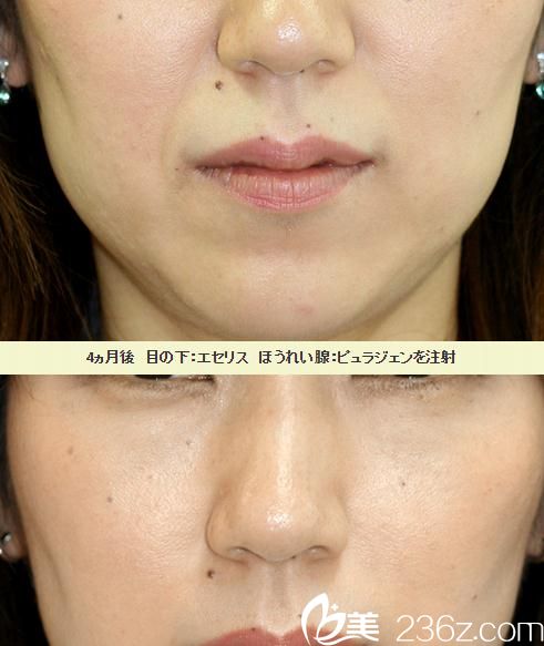 微整注射去法令纹 微整注射去法令纹