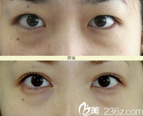 开眼角+埋线双眼皮