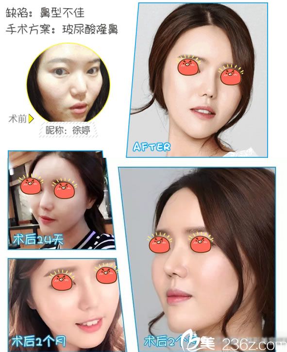 绍兴艺美雷金同注射玻尿酸隆鼻案例