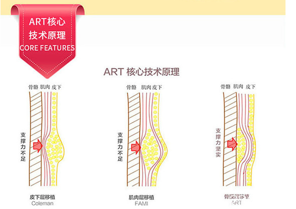北京上上相脂肪填充技术核心技术示意图