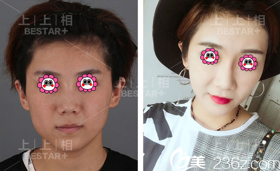 北京上上相自体脂肪面部填充多少钱？郑楚蓉黄罡案例及价格参考