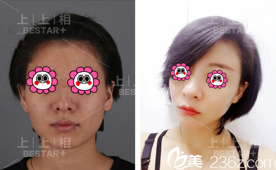 北京上上相黄罡自体脂肪面部填充案例