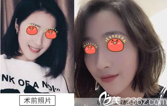 伊婉与艾莉薇哪个隆鼻好