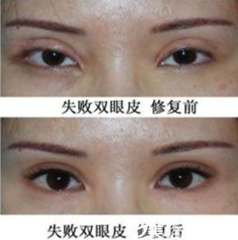 衡阳雅美眼失败修复真人案例