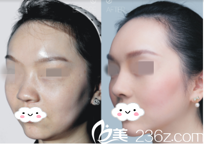 衡阳雅美鼻综合真人案例