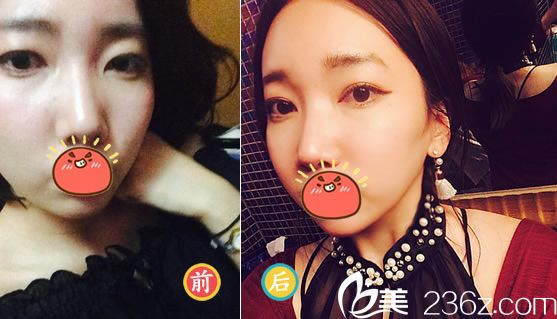 绍兴艺美方伦磊全切双眼皮案例