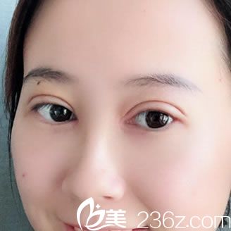 我刚做了双眼皮和开内外眼角手术,预约的是杭州爱度医美的刘晋军院长