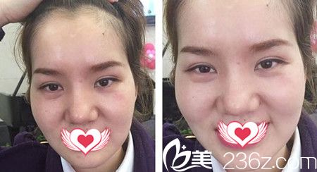 在雅美做自体脂肪填充额头与太阳穴术前照 在雅美做自体脂肪填充额头与太阳穴术前照