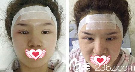 做自体脂肪填充额头与太阳穴术后天 做自体脂肪填充额头与太阳穴术后天