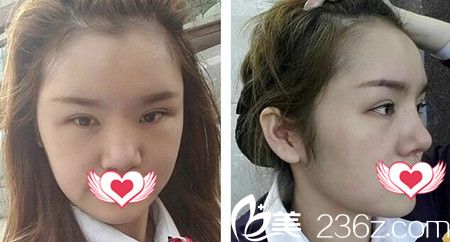 做自体脂肪填充额头与太阳穴术后一周 做自体脂肪填充额头与太阳穴术后一周