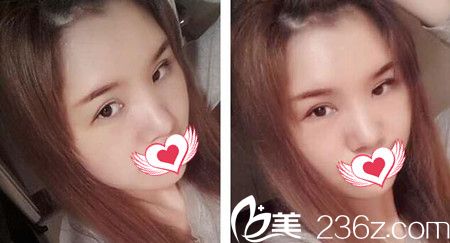 做自体脂肪填充额头与太阳穴术后20天效果 做自体脂肪填充额头与太阳穴术后20天效果