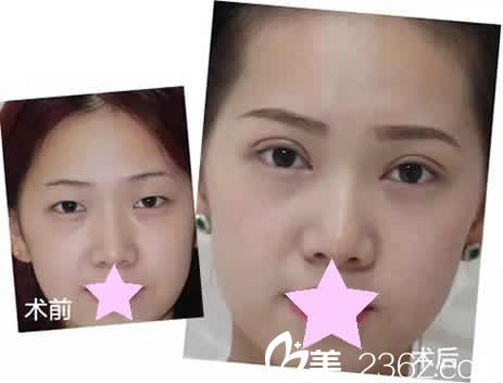 太原善美整形双眼皮加开眼角前后对比图 太原善美整形双眼皮加开眼角前后对比图