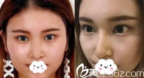 太原善美整形假体隆鼻案例效果 太原善美整形假体隆鼻案例效果