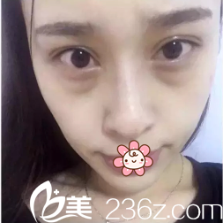 我的眼袋太明显 我的眼袋太明显