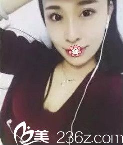 毕胜祛眼袋术后半个月 毕胜祛眼袋术后半个月