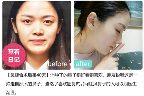 深圳美莱医院周年庆优惠整形价格表 双眼皮6300元,隆鼻子8800元,隆胸16800元