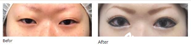 广岛美容外科医院埋设法双眼皮