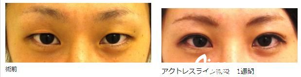 中森大记的埋线双眼皮