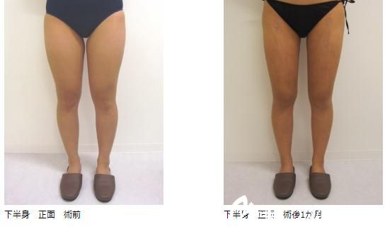 中森大记的吸脂手术