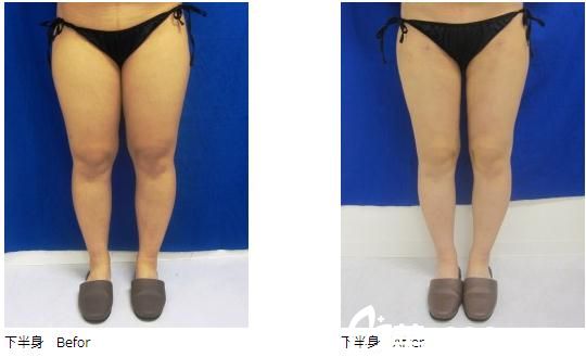 广岛美容外科医院吸脂手术