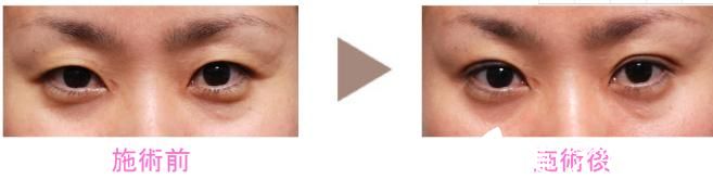 新垣形成外科医院 埋设双眼皮 新垣形成外科医院 埋设双眼皮