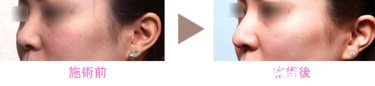 日本新垣形成外科医院隆鼻 日本新垣形成外科医院隆鼻