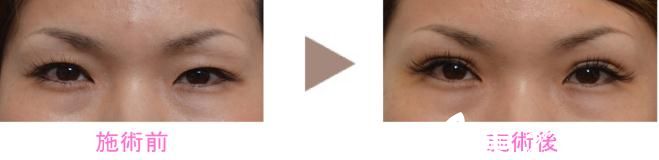 新垣实埋线双眼皮 新垣实埋线双眼皮