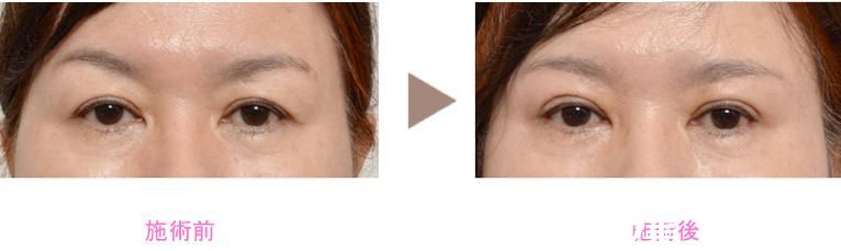 新垣实眼睑下垂修正 新垣实眼睑下垂修正