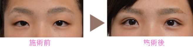 野村宏史埋线 野村宏史埋线