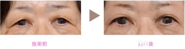 野村宏史 眼睑下垂修正 野村宏史 眼睑下垂修正