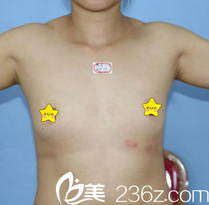 东营艺美李琳假体隆胸整形真人案例 东营艺美李琳假体隆胸整形真人案例