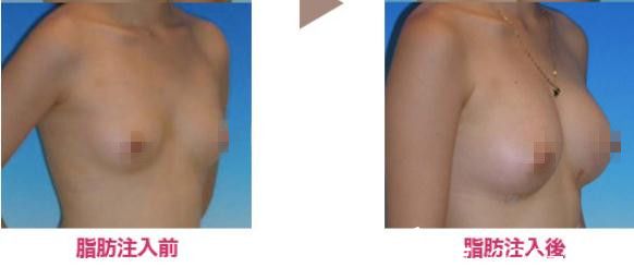 野村宏史脂肪丰胸 野村宏史脂肪丰胸