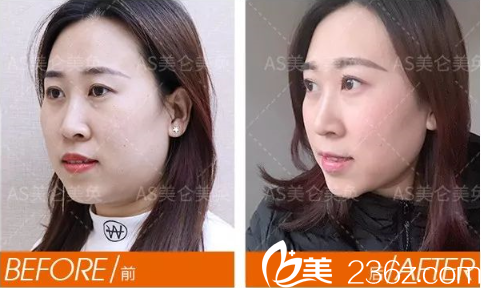 重庆美仑美奂面部提升案例 重庆美仑美奂面部提升案例