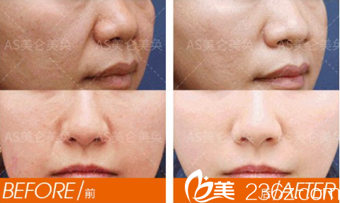 重庆美仑美奂去法令纹案例 重庆美仑美奂去法令纹案例