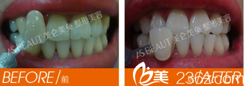 重庆美仑美奂皓齿美白案例 重庆美仑美奂皓齿美白案例