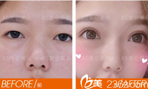 重庆美仑美奂做双眼皮怎么样 重庆美仑美奂做双眼皮怎么样