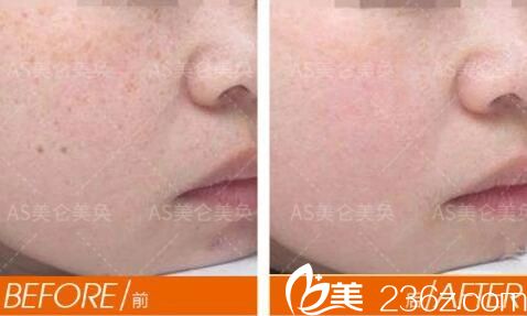 重庆美仑美奂超皮秒嫩肤案例 重庆美仑美奂超皮秒嫩肤案例