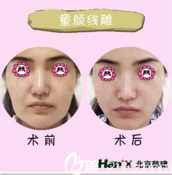 北京韩啸医院埋线提升多少钱？童颜线雕案例价格表参考