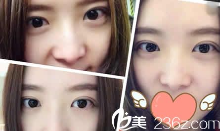 大同清木整形姜际珠双眼皮加开眼角案例图 大同清木整形姜际珠双眼皮加开眼角案例图