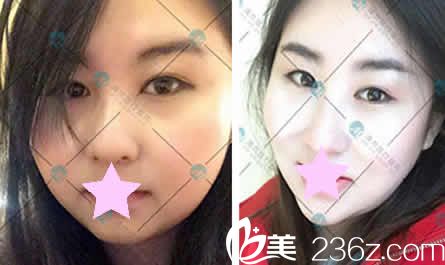 大同清木整形面部吸脂前后对比图 大同清木整形面部吸脂前后对比图