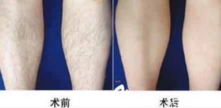 大同清木整形激光脱腿毛效果图 大同清木整形激光脱腿毛效果图