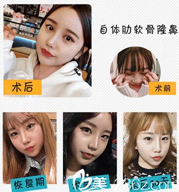 常州美贝尔隆鼻<span style= 常州美贝尔隆鼻<span style=