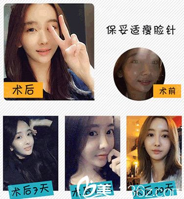 我在常州美贝尔打了瘦脸前后对比照 我在常州美贝尔打了瘦脸前后对比照