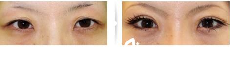 切开法双眼皮修复1 切开法双眼皮修复1