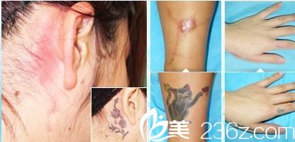 刺青伤疤去除 刺青伤疤去除