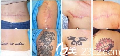 山本丰刺青伤疤去除