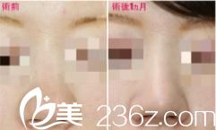 肉鼻修复