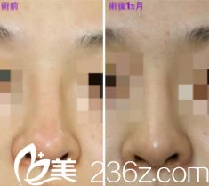 鼻中隔延长修复