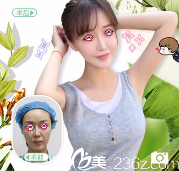 北京纯脂冯斌脂整形王自谦医生自体脂肪面部填充 北京纯脂冯斌脂整形王自谦医生自体脂肪面部填充